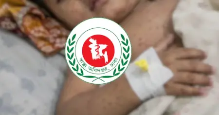 দেশে হাম-উপসর্গে আক্রান্ত হয়ে আরও এক শিশুর মৃ’ত্যু