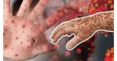 সারাদেশে গত ২৪ ঘণ্টায় হামে আরও ৮ শিশুর মৃত্যু, নতুন আক্রান্ত ১,১৭১